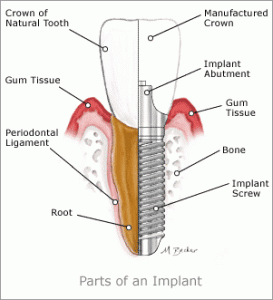 Dental Implant compared to a natural tooth