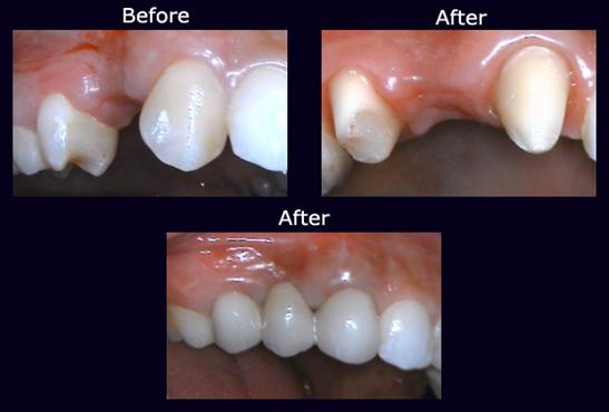 What does a dental bridge correct?