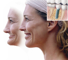 Sandy springs dental implants