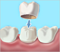 Ceramic Dental Crown